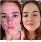 LIMETOW™ Herbal Acne Removing Cream