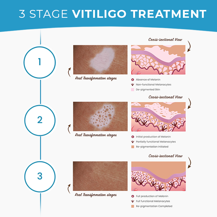 MEDix™ Vitiligo Treatment Cream