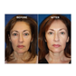 ShapeZ™ EMS Red Light Face Treatment